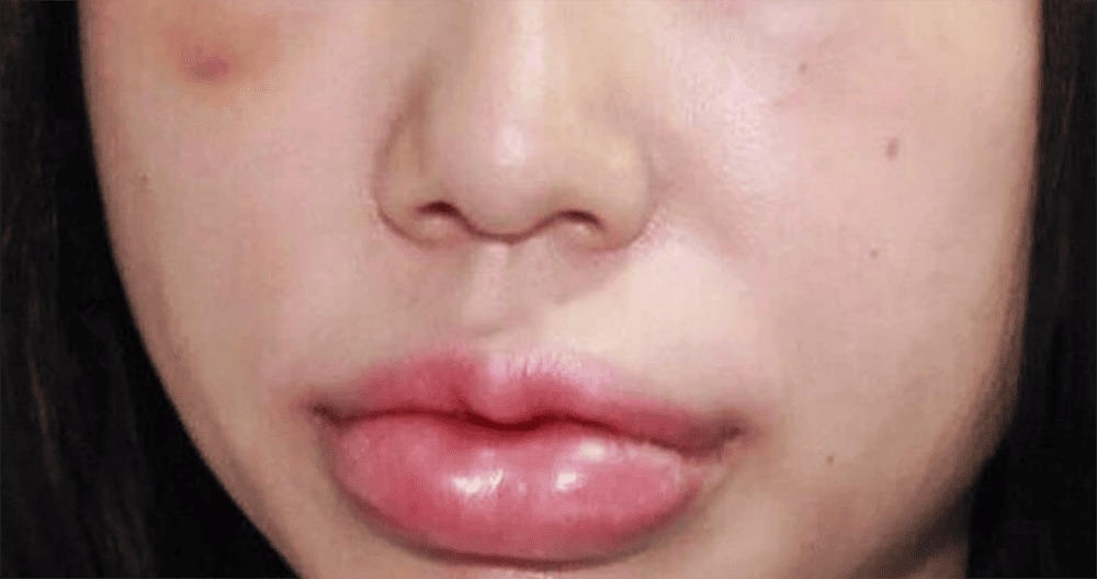 Nguyên nhân tiêm filler bị sưng tấy đau nhức