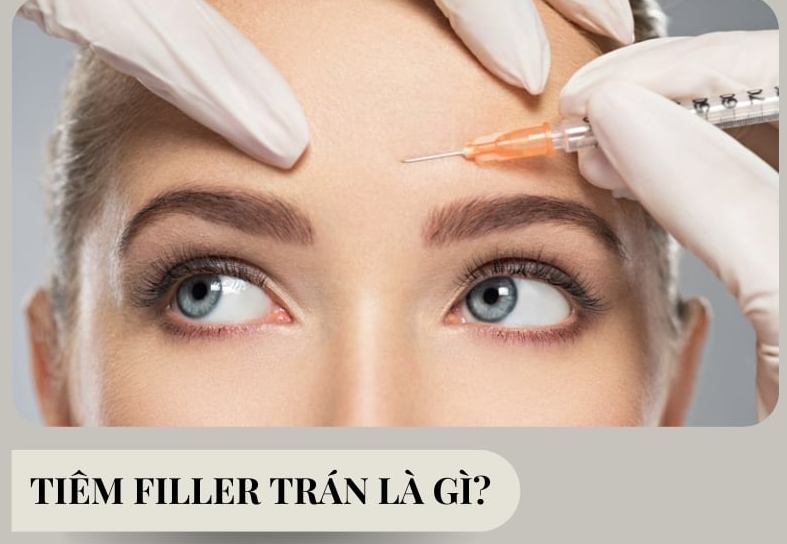tiêm filler trán là gì