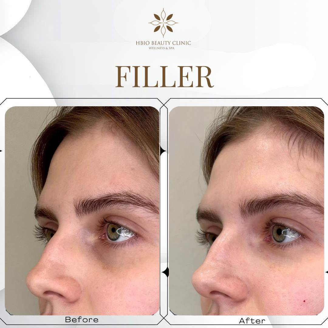 trước và sau khi tiêm filler trán