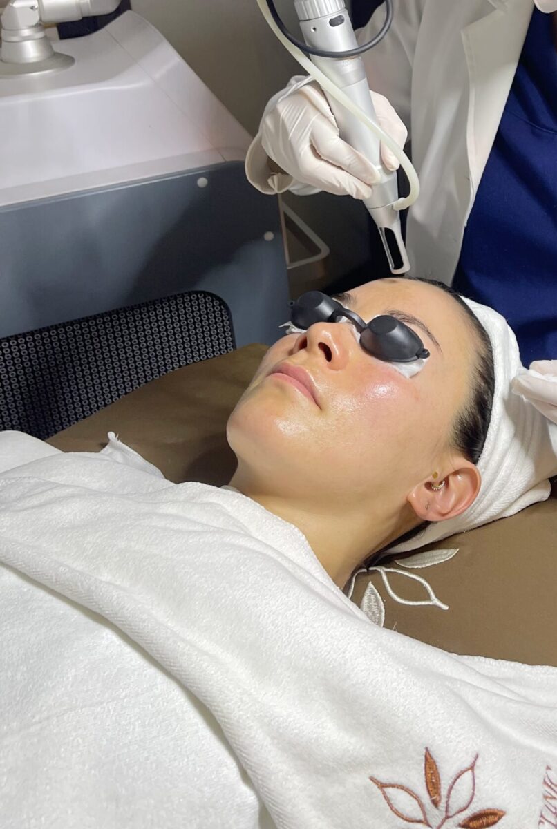 Điều trị mụn trứng cá bằng Laser ND:YAG