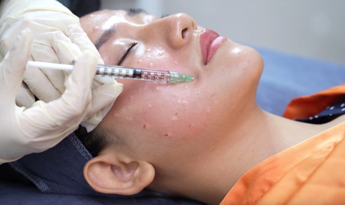 Ai phù hợp tiêm meso trị nám?