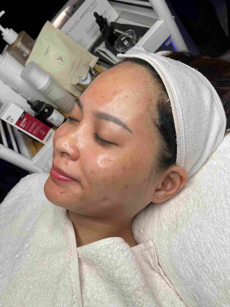 Bao lâu thì peel da 1 lần là tốt nhất?