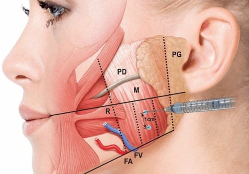 Botox có nguy hiểm không?