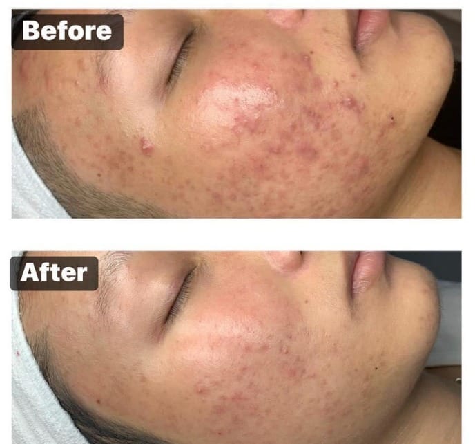 Các phương pháp điều trị mụn viêm