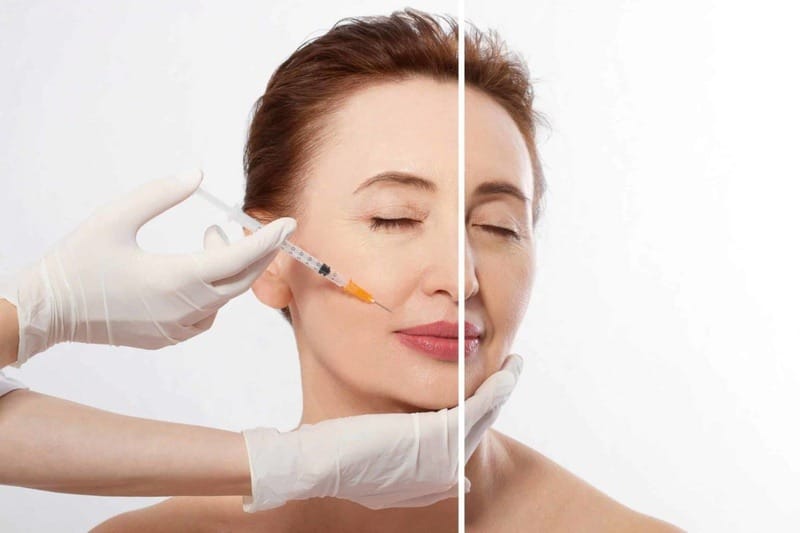 Cách Giữ Kết Quả Tiêm Filler