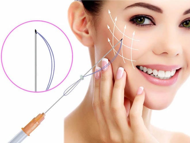 Căng chỉ Collagen (Thread Lift)