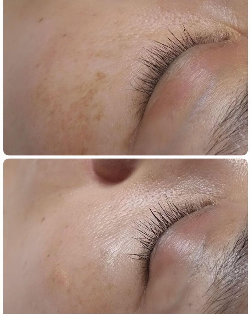 Điều trị nám da tại HBIO Clinic