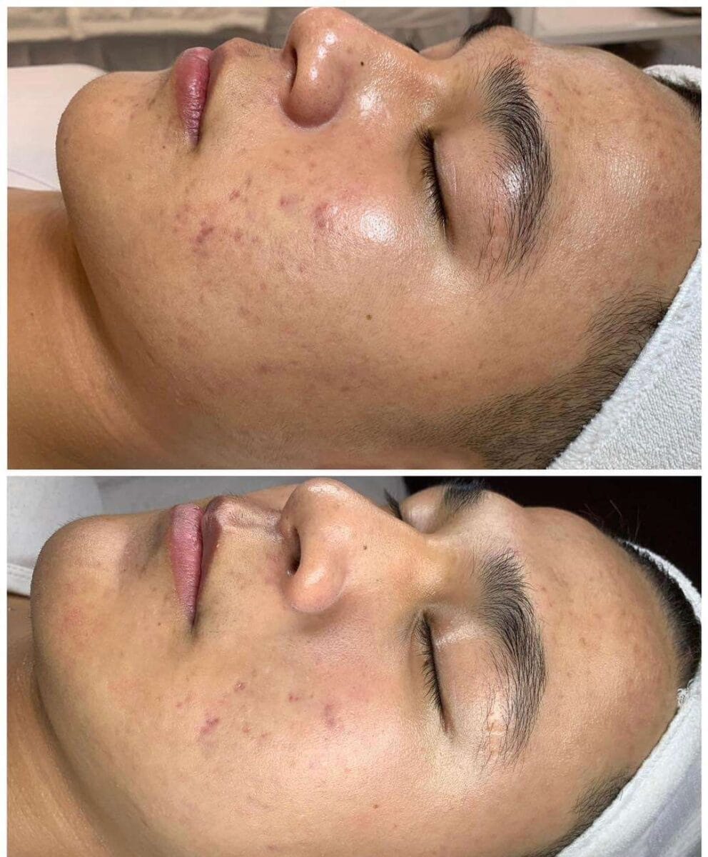 Hình ảnh khách hàng trước và sau tiêm meso trị mụn