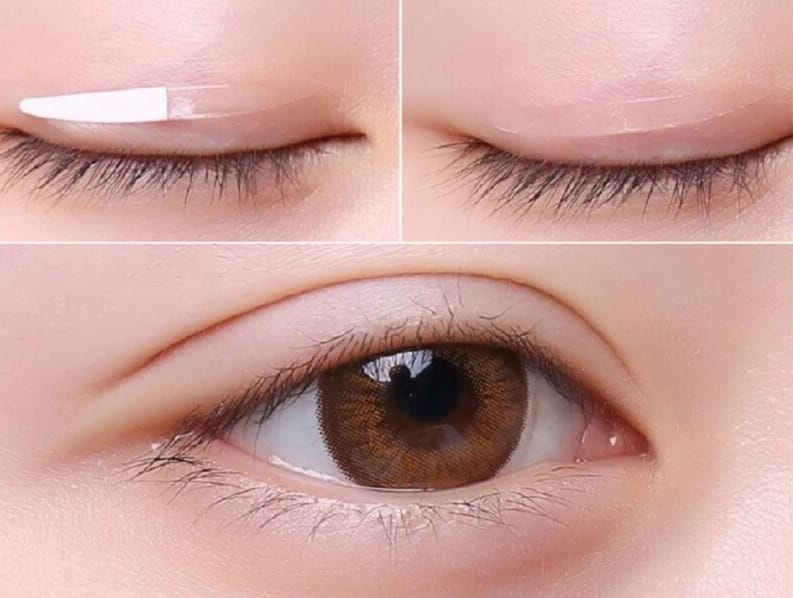 Khắc phục tình trạng mất cân đối mắt bằng dán kích mí