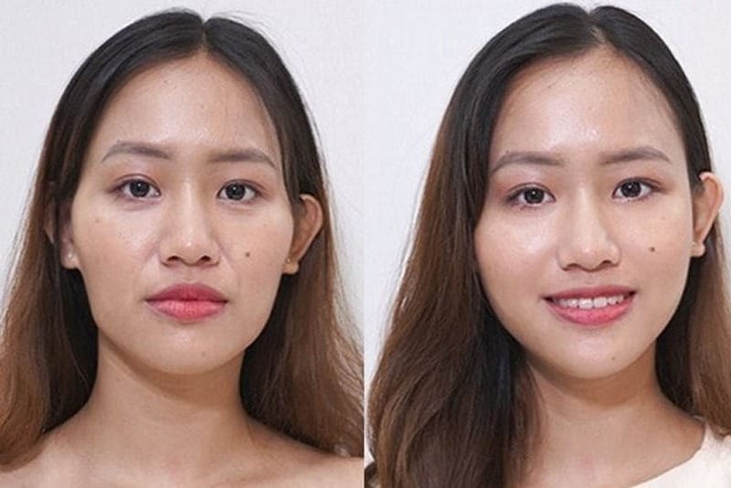 Lượng filler cần tiêm là bao nhiêu?