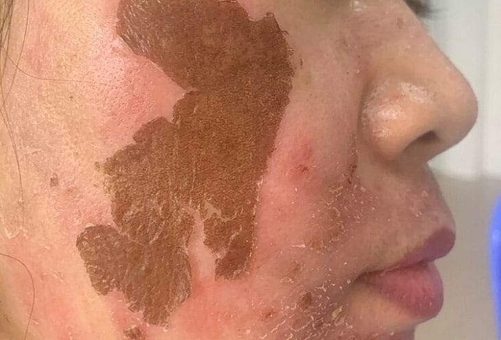 Lý do nên chú trọng việc chăm sóc da sau laser trị nám