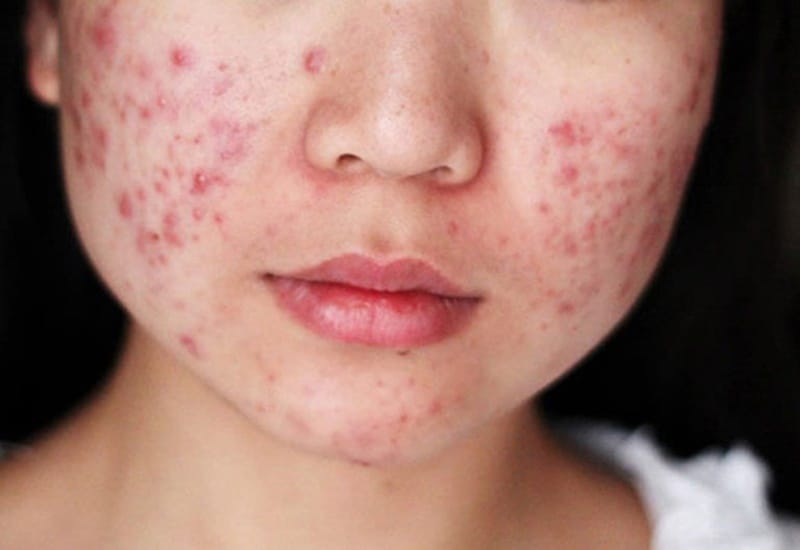 Mụn trứng cá là gì?