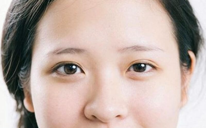 Nguyên nhân gây nên hiện tượng mắt to mắt nhỏ