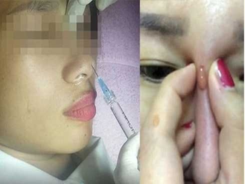 Nguyên nhân gây ra tiêm filler mũi bị tràn