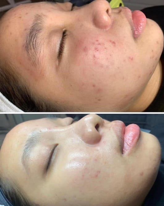 Những lợi ích của peel da