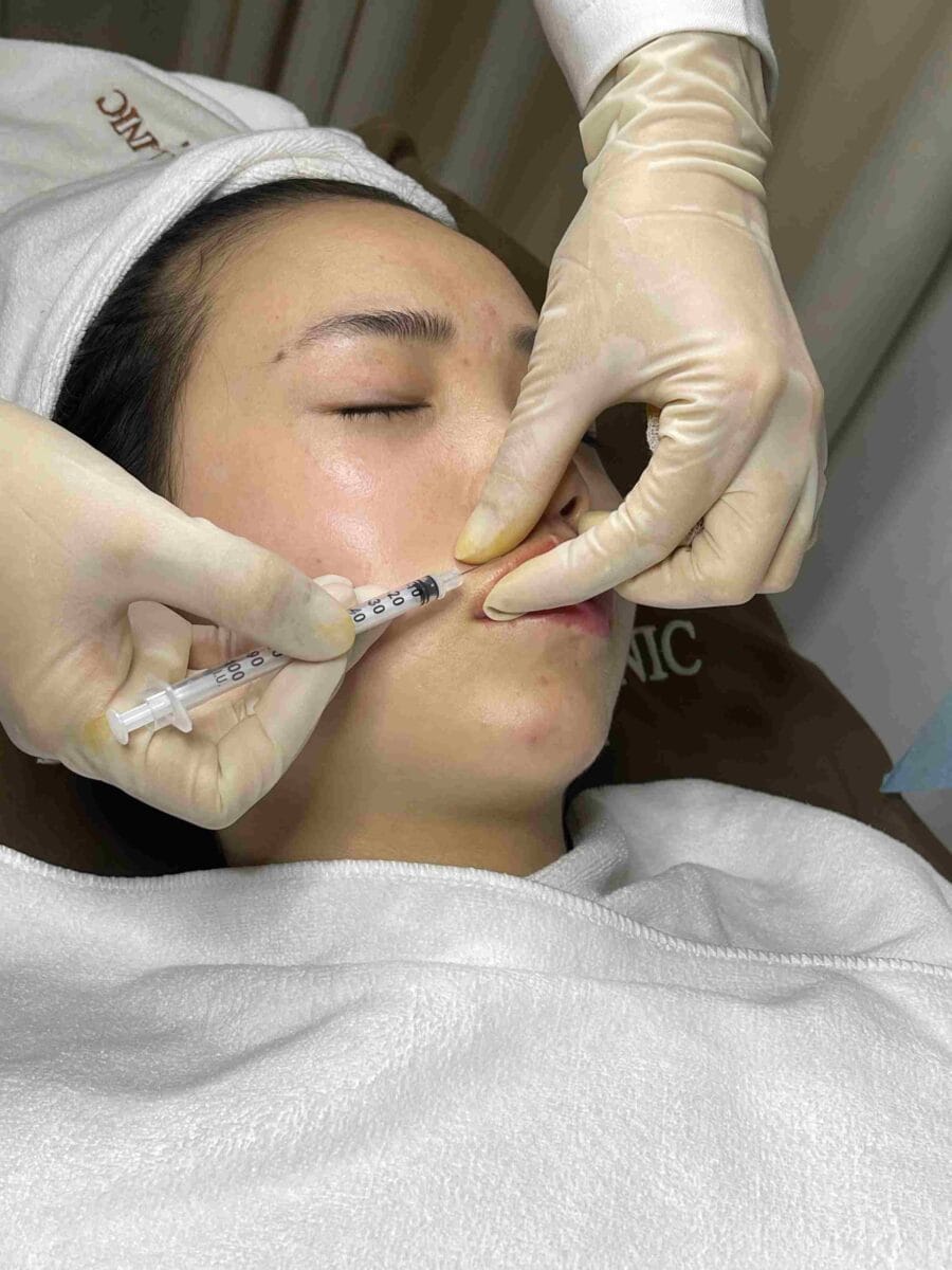 Những lưu ý khi tiêm filler