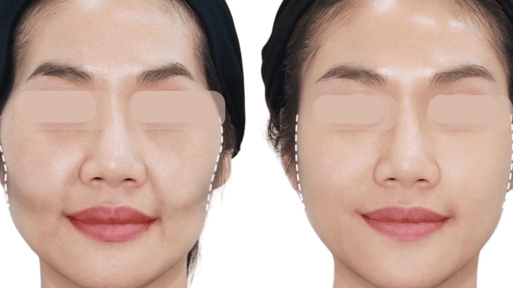 Những phương pháp làm đầy má hóp tự nhiên hiệu quả