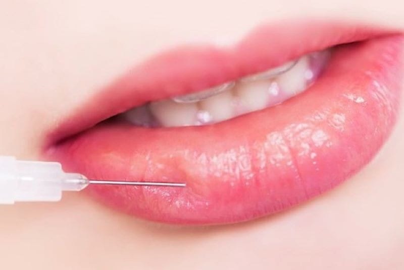 Những yếu tố ảnh hưởng đến việc sử dụng filler