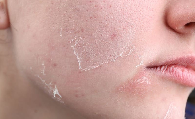 Peel da để tái tạo da hiệu quả