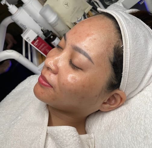 Peel da trị thâm mụn là gì?