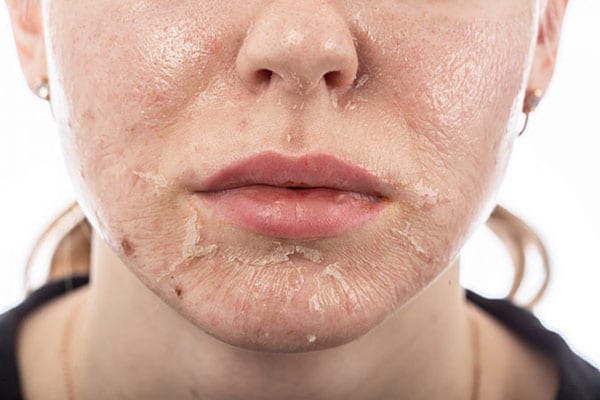 Tái tạo da là quá trình loại bỏ các tế bào da cũ