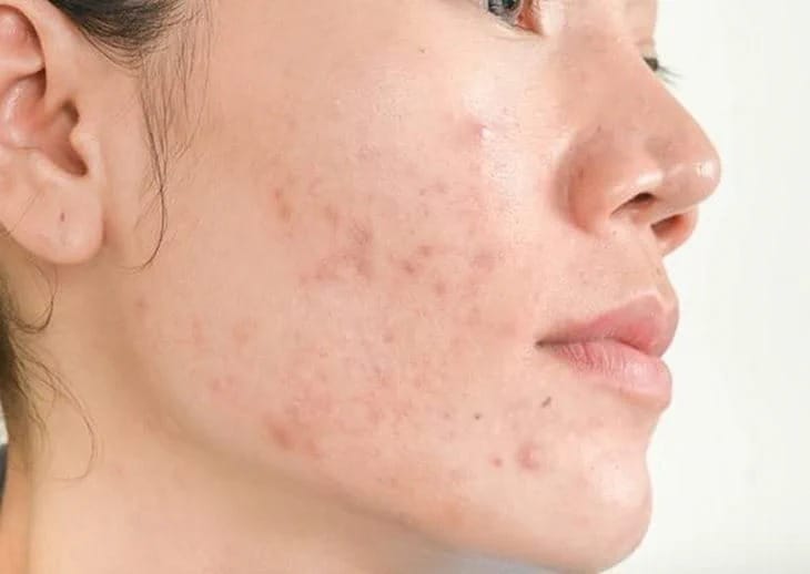 Thâm mụn là gì?