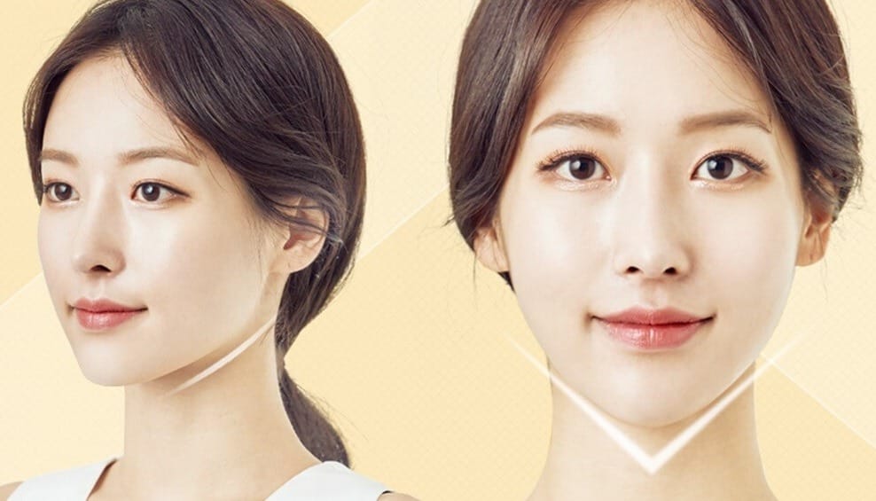 Tiêm cằm giữ được bao lâu là câu hỏi được nhiều người quan tâm