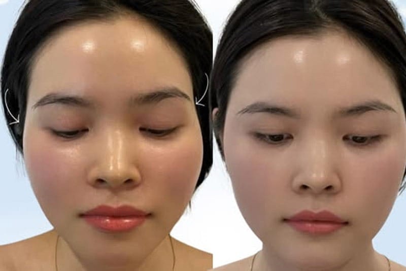 Tiêm filler để được bao lâu sẽ do cơ địa và tốc độ trao đổi chất