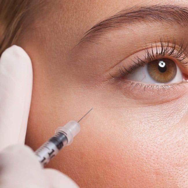 Tiêm filler hốc mắt hiện đang là một phương pháp thẩm mỹ rất phổ biến