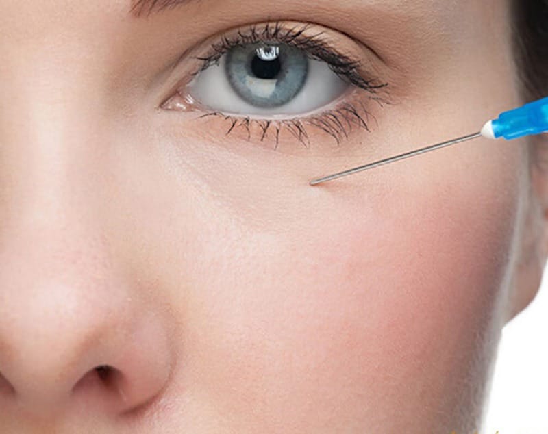 Tiêm filler hốc mắt là một phương pháp thẩm mỹ