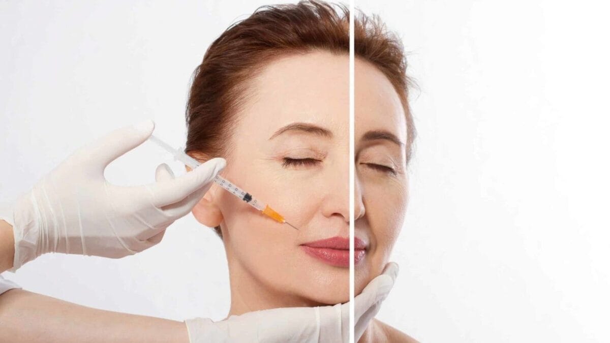 Tiêm filler là gì và filler có tự tan không?