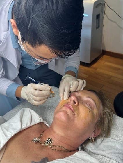 Tiêm Filler làm đầy má hóp