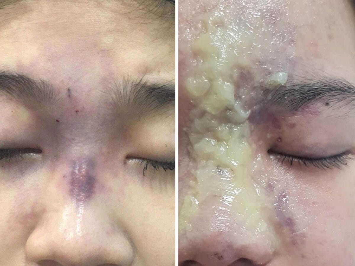 Tiêm filler mũi có bị tràn không?