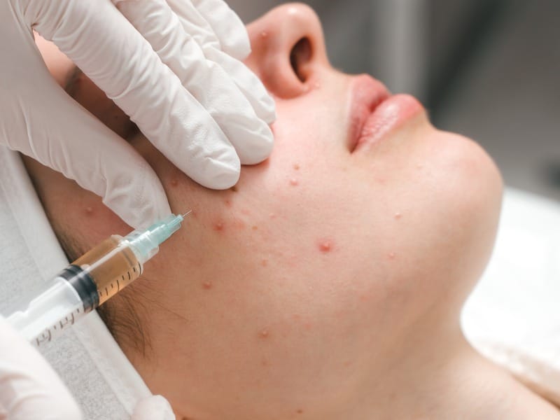 Ưu điểm của tiêm meso trị mụn