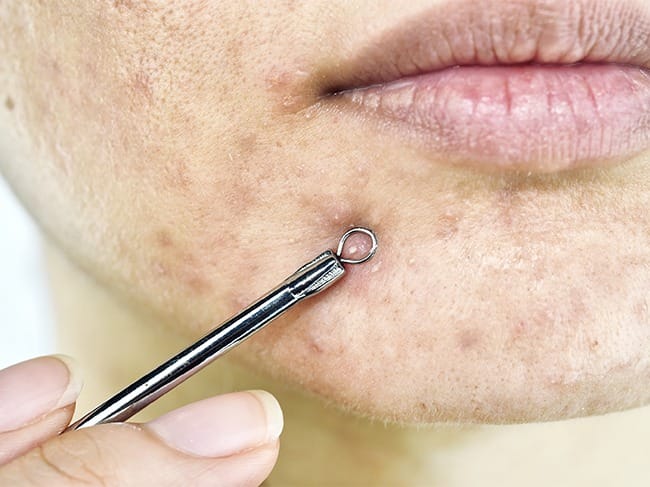 Xác định nguyên nhân thâm mụn giúp chọn đúng cách điều trị