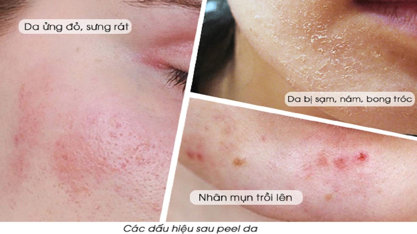 Các hiện tượng có thể xảy ra sau peel da