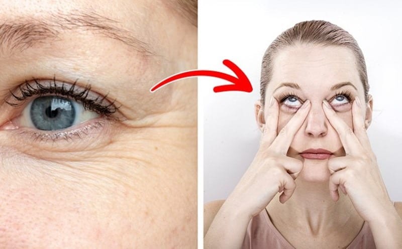 Các loại nếp nhăn quanh mắt