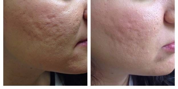 Scar treatment methods