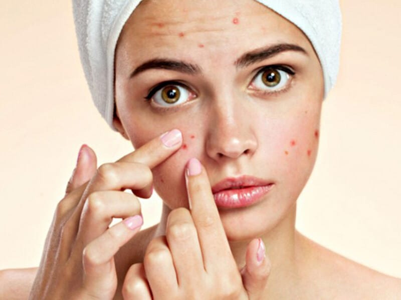 How to treat red, swollen acne at home properly