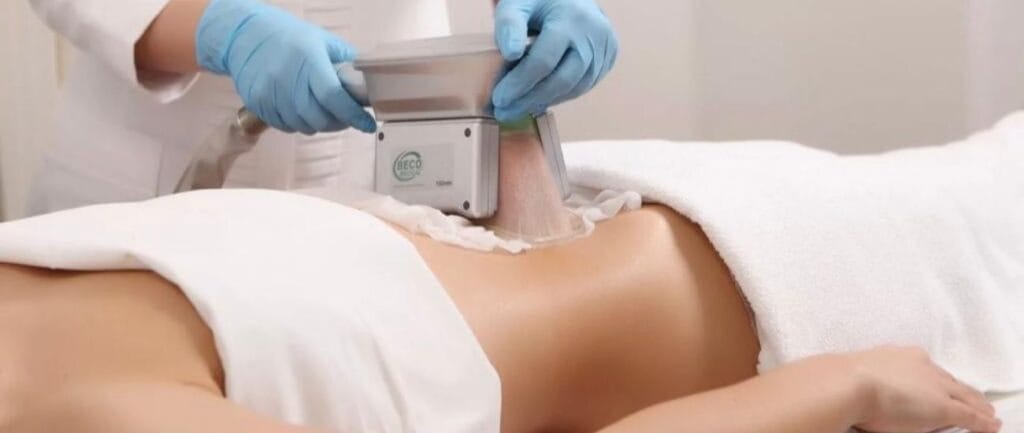 Cryolipolysis hay CoolSculpting