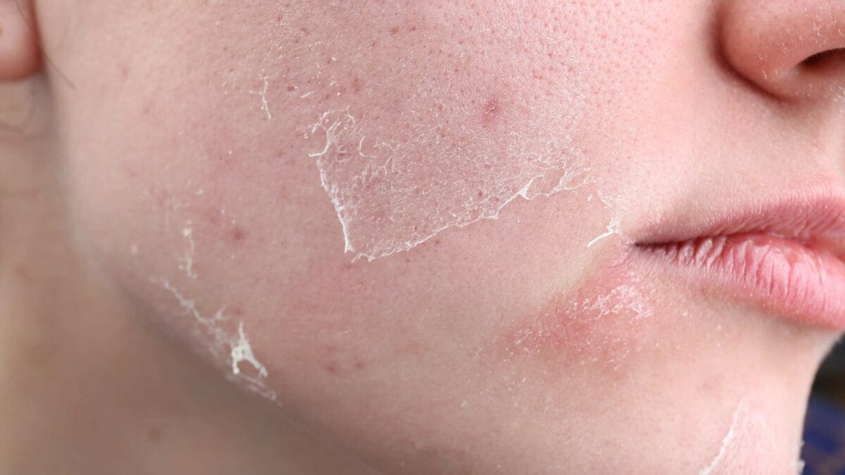 Da khô (Dry Skin)