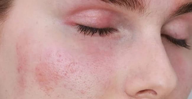 Da nhạy cảm (Sensitive Skin)