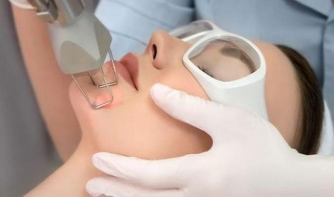 Điều trị mụn ẩn bằng công nghệ thẩm mỹ tại HBIO Clinic