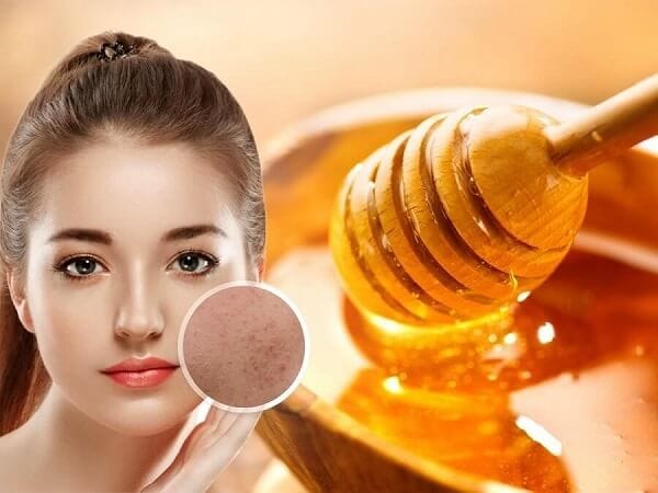 ĐIều trị mụn ẩn bằng mặt nạ thiên nhiên