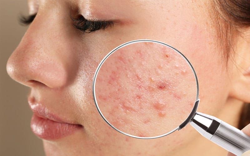 Hình ảnh mụn nội tiết 