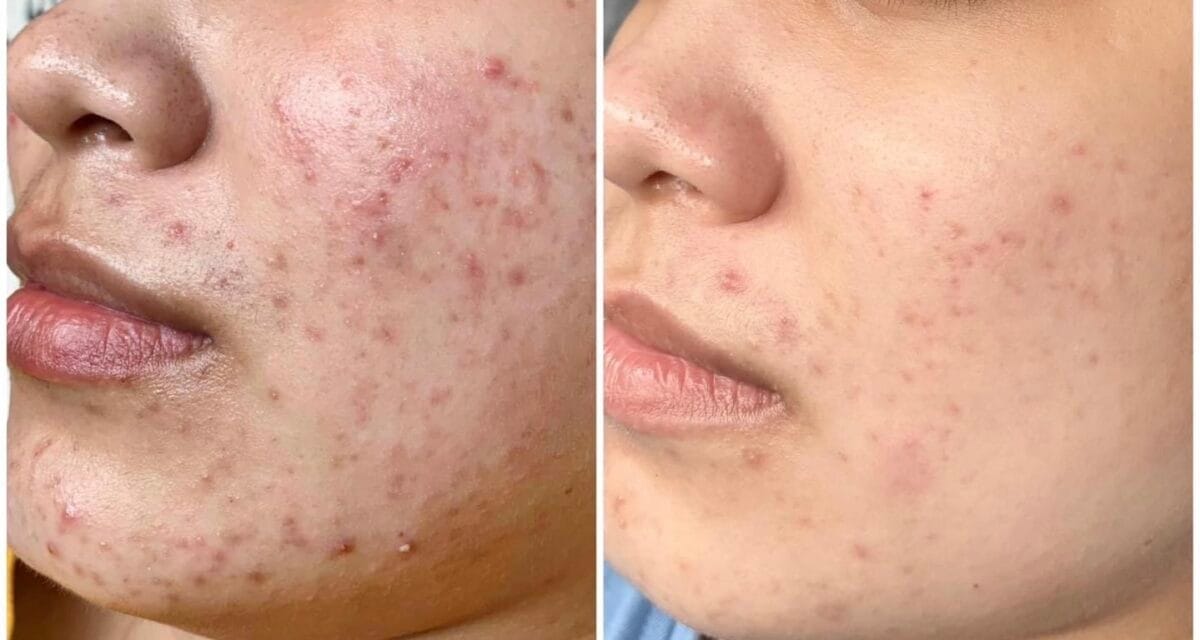 Hình ảnh thực tế khách hàng điều trị mụn bọc tại HBIO Clinic