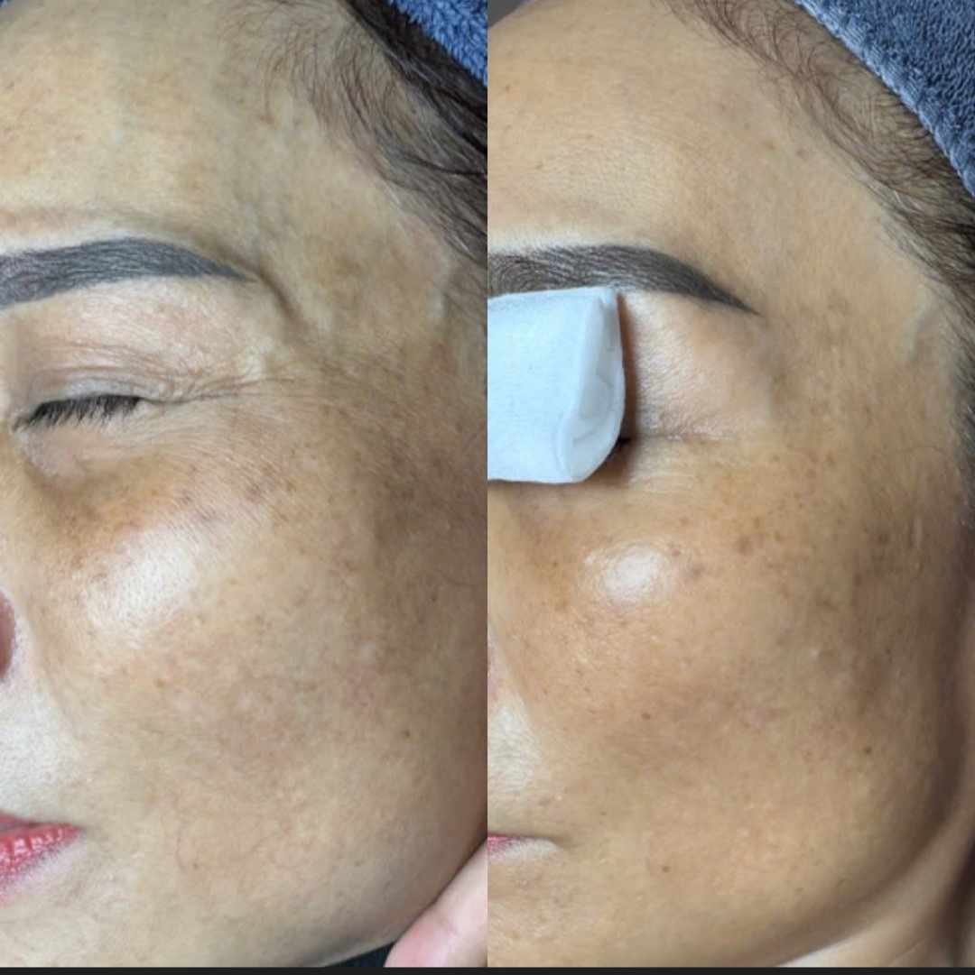 Hình ảnh trước và sau khi tiêm Botox xóa nhăn mắt 1