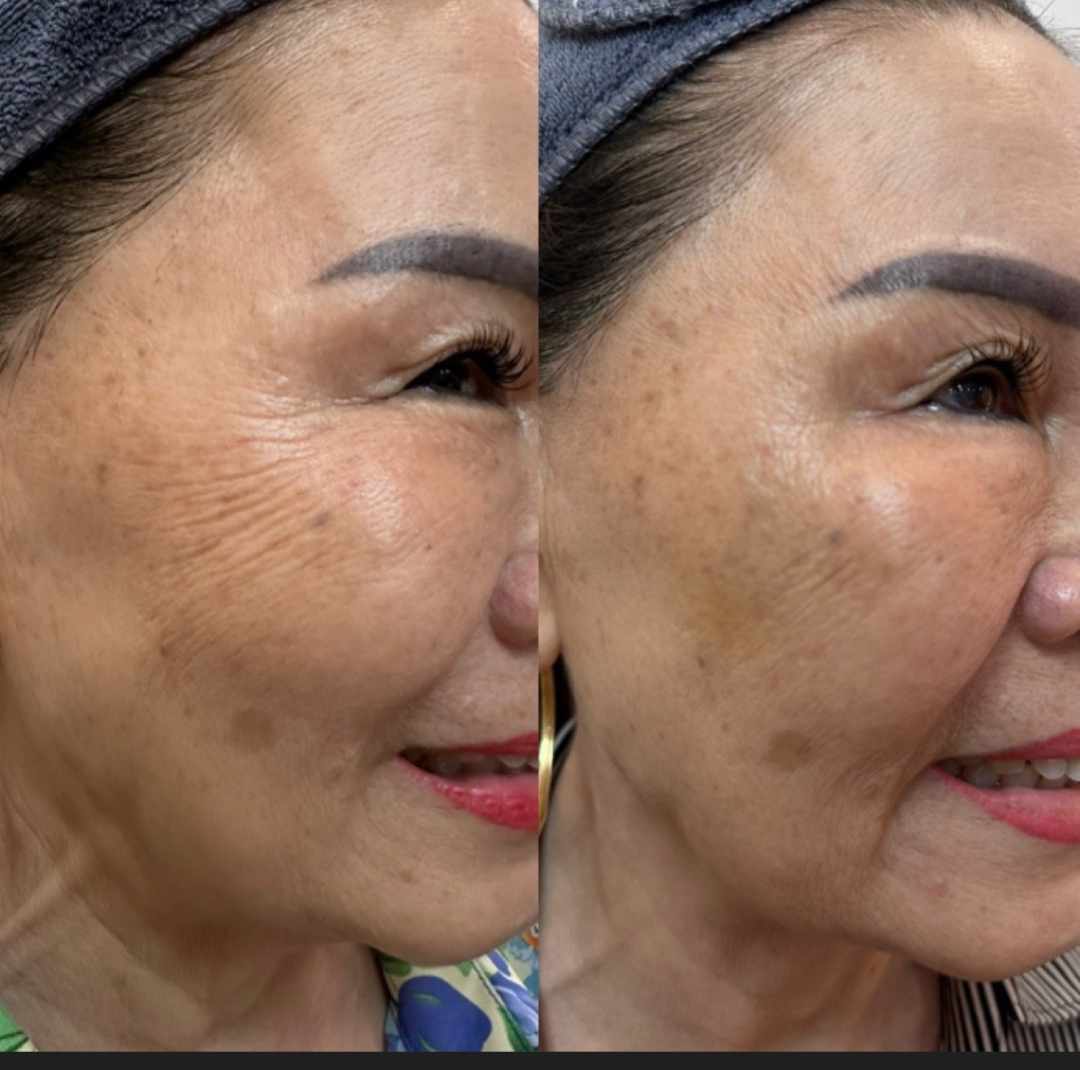 Hình ảnh trước và sau khi tiêm Botox xóa nhăn mắt