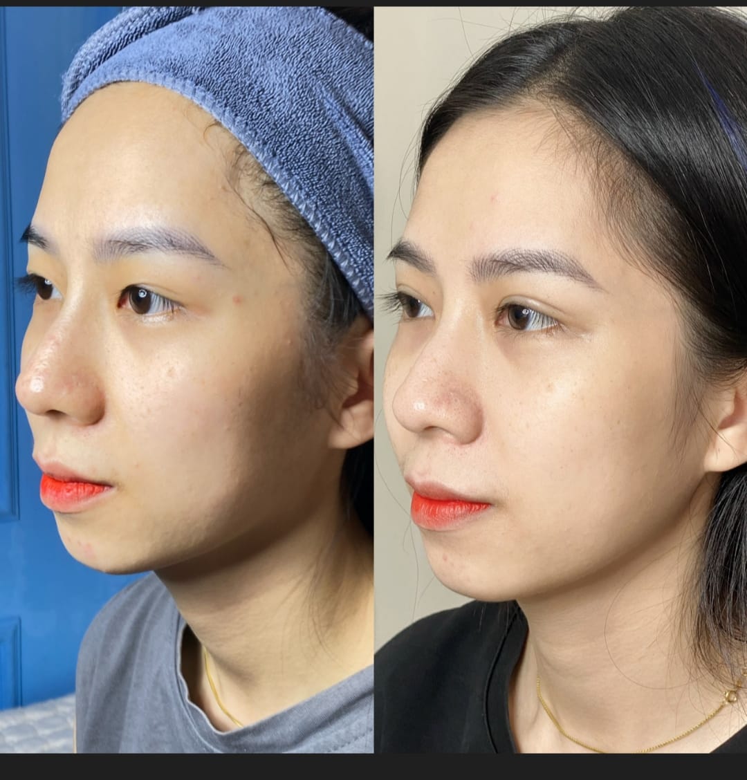 Kết quả rõ rệt trước và sau liệu trình trẻ hoá da tại HBIO Clinic 1