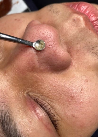 Không tẩy tế bào chết thường xuyên